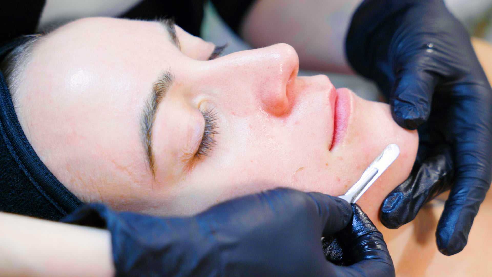 Dermaplaning treatment at BC Medical Clinic